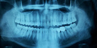 descodificacion dental dientes, odontología, alternativas