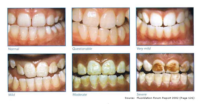 IMPACTO de fluorose dental em seus dentes - Saúde Forever Living