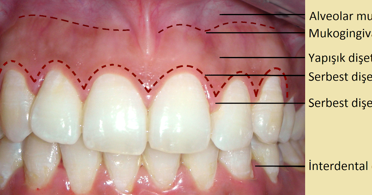 Dişeti Sağlığı ve Hastalıkları Serbest Dişeti Grefti