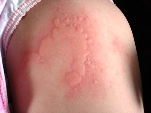 pictures of allergic reactions