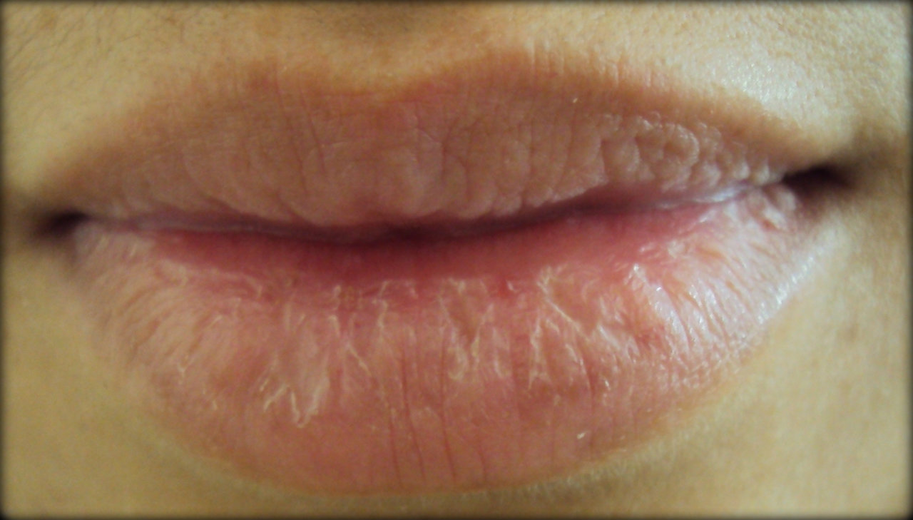 Сухость и раздражение губ. Сухость и раздражение губ. Сложенные губы. Сухость и раздражение губ. Хейлит манганотти гистология.