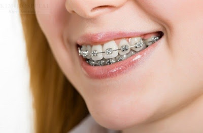 Thông tin về các loại niềng răng thẩm mỹ