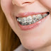 Thông tin về các loại niềng răng thẩm mỹ