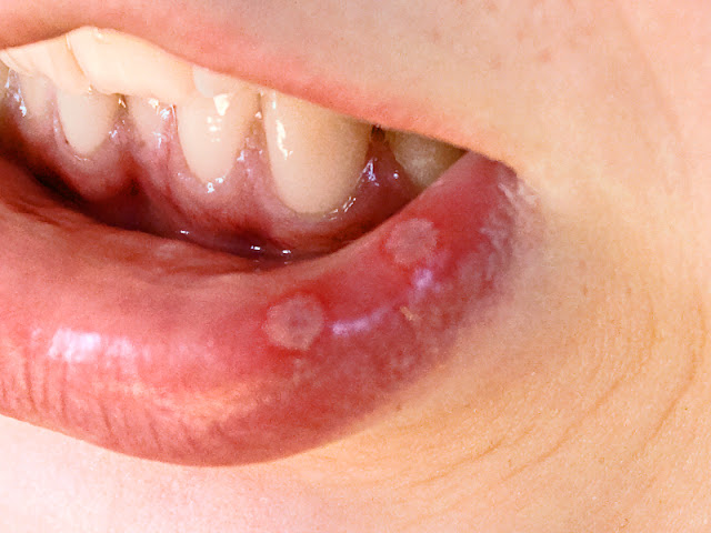 mouth ulcers treatment, mouth ulcer home remedies