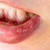 मुंह के छाले से छुटकारा पाने के 4 बेहतरीन उपाय | Mouth Ulcers Treatment