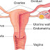 Nội mạc tử cung dày là nguyên nhân gây vô sinh và rong sinh