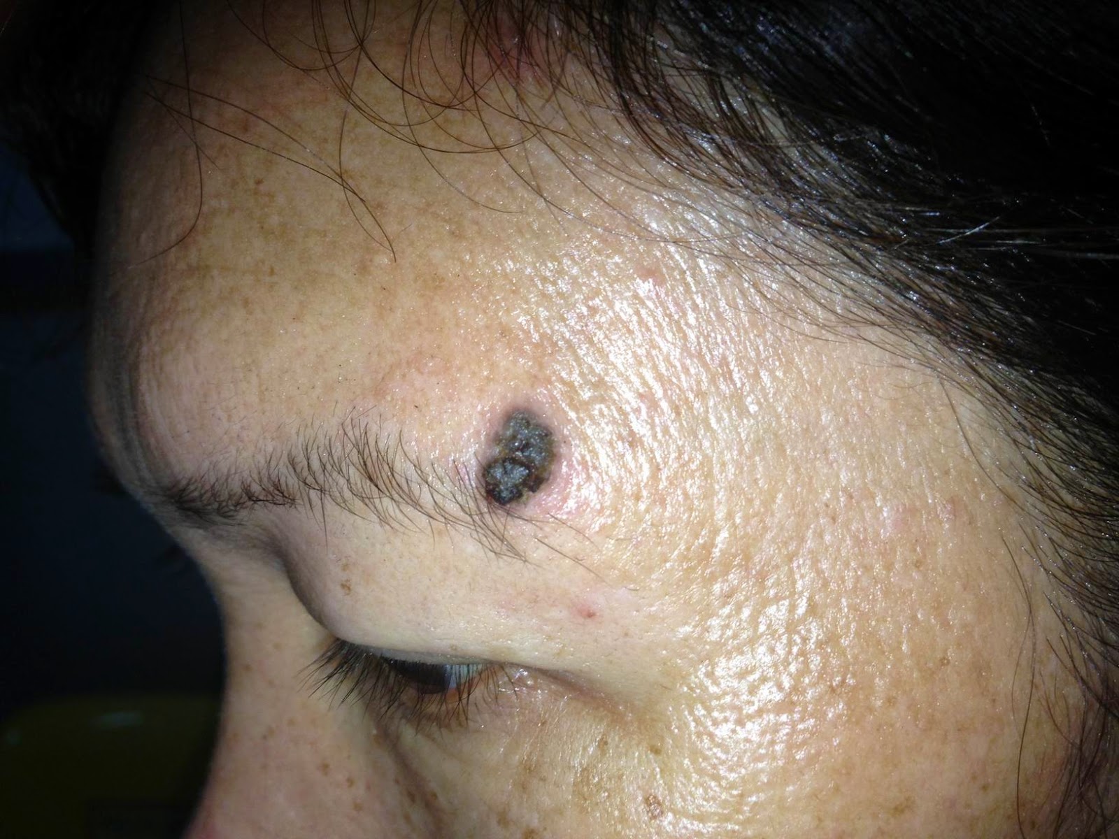 VIETNAMESE MEDIC ULTRASOUND CASE 288 BLACK SKIN TUMOR, Dr PHAN THANH