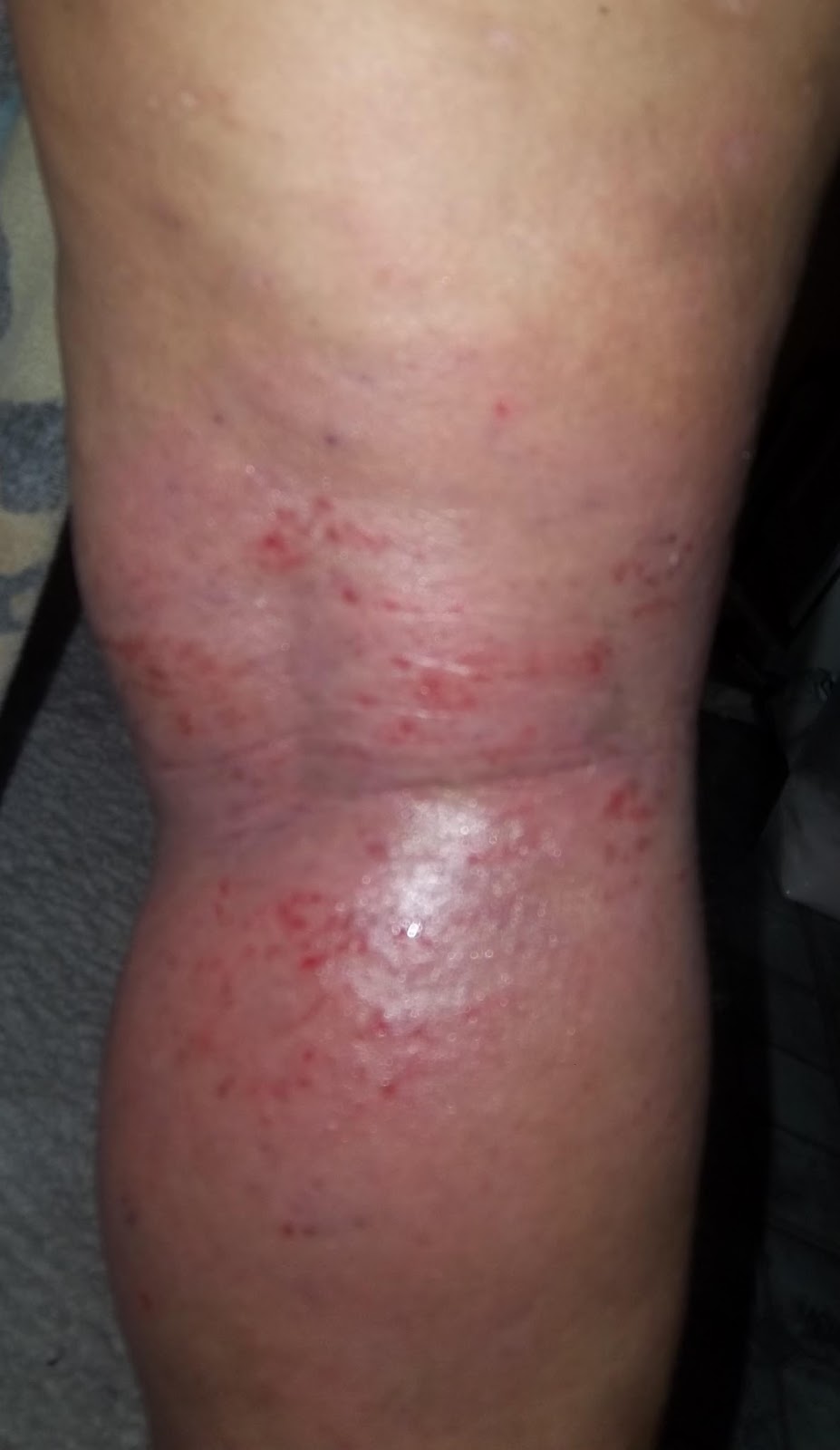 Stopping Topical Steroids : July 2013