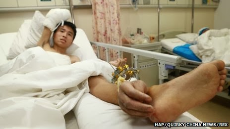 بالصور صيني يزرع يده في قدمه حتى لا تموت