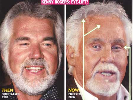 dolly parton plastic surgery
