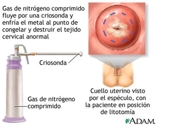 El tratamiento del cáncer de próstata congela el área del cáncer. El tratamiento del cáncer de próstata congela el área del cáncer.