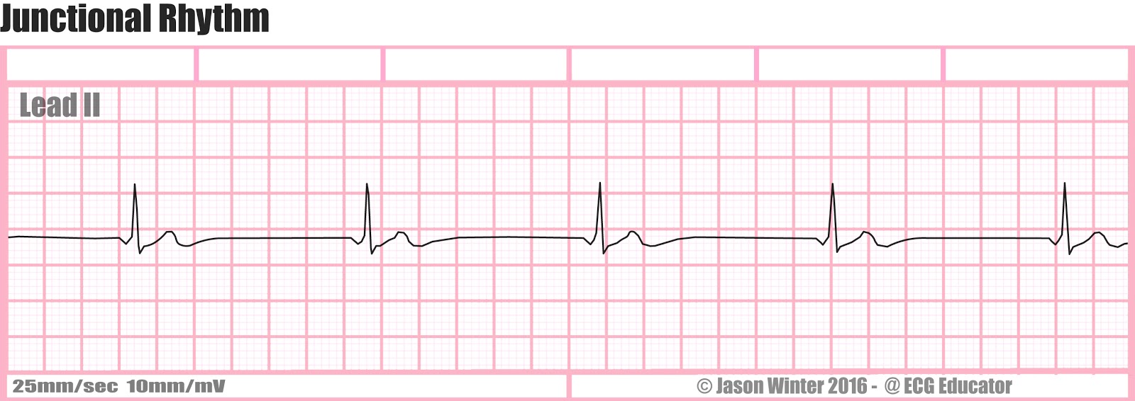 ECG Educator Blog Junctional Rhythms ecg-educator-blog-junctional-rhythms