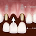  Cấy ghép Implant gắn răng liền có tốt không?