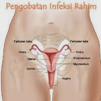 Pengobatan Infeksi Rahim