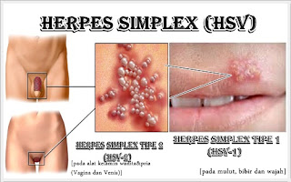 Obat Herpes De Nature Di Apotik Umum