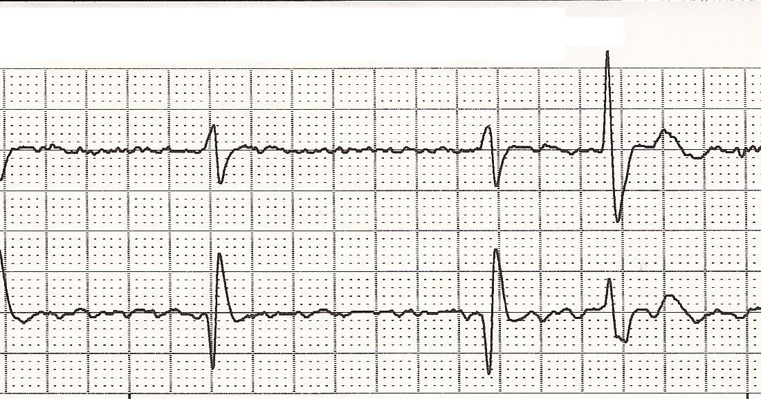 ECG Rhythm Strips 74