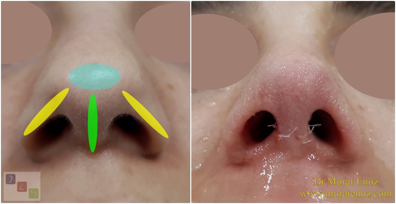 We Performed Nose Tip Plasty Operation Using Alar Rim Grafts!