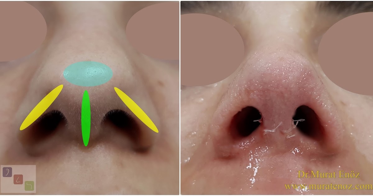 We Performed Nose Tip Plasty Operation Using Alar Rim Grafts!