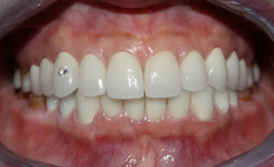  Răng sứ thẩm mỹ có bền không?