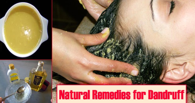 Prevent Dandruff Naturally