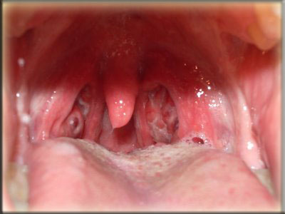 Inflammation In Throat 51