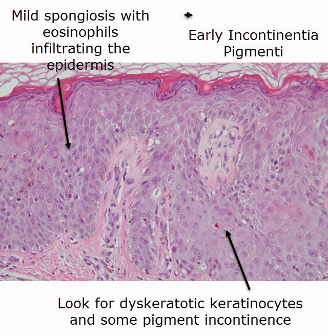 Dermatopathology Made Simple Inflammatory Spongiotic Reaction Pattern