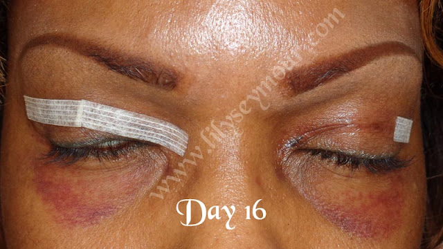 African American Ethnic Blepharoplasty (Eyelid Surgery)