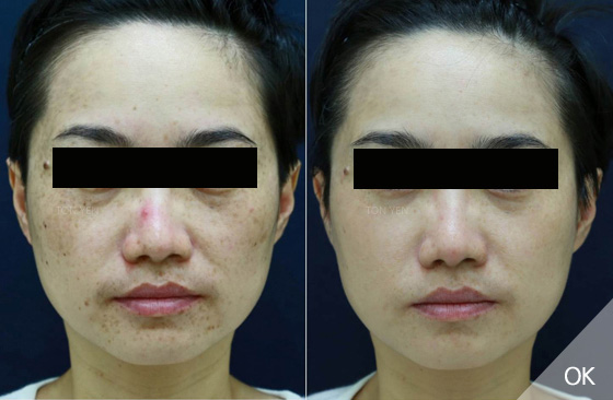 皮秒雷射案例B，因為天生皮膚白皙，所以臉上的深淺斑點更加明顯，經光澤珍所的醫師施打皮秒雷射的療程之後，斑點困擾有效改善，且沒有術後反黑的情形。