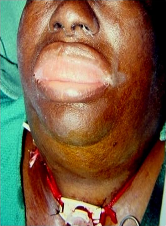 Cellulitis Of The Mouth 15