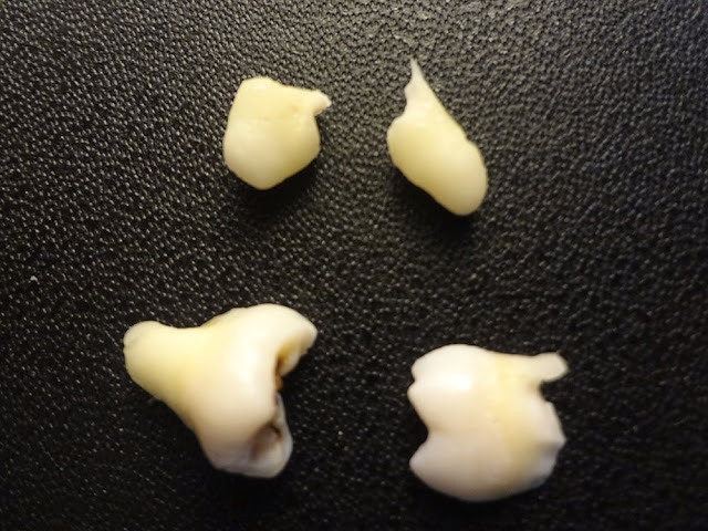 picture of extracted wisdom tooth