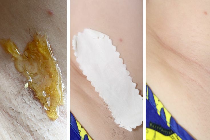 Bersihkan Bulu Ketiakmu Secara Permanen dengan Bahan Alami ini! Begini