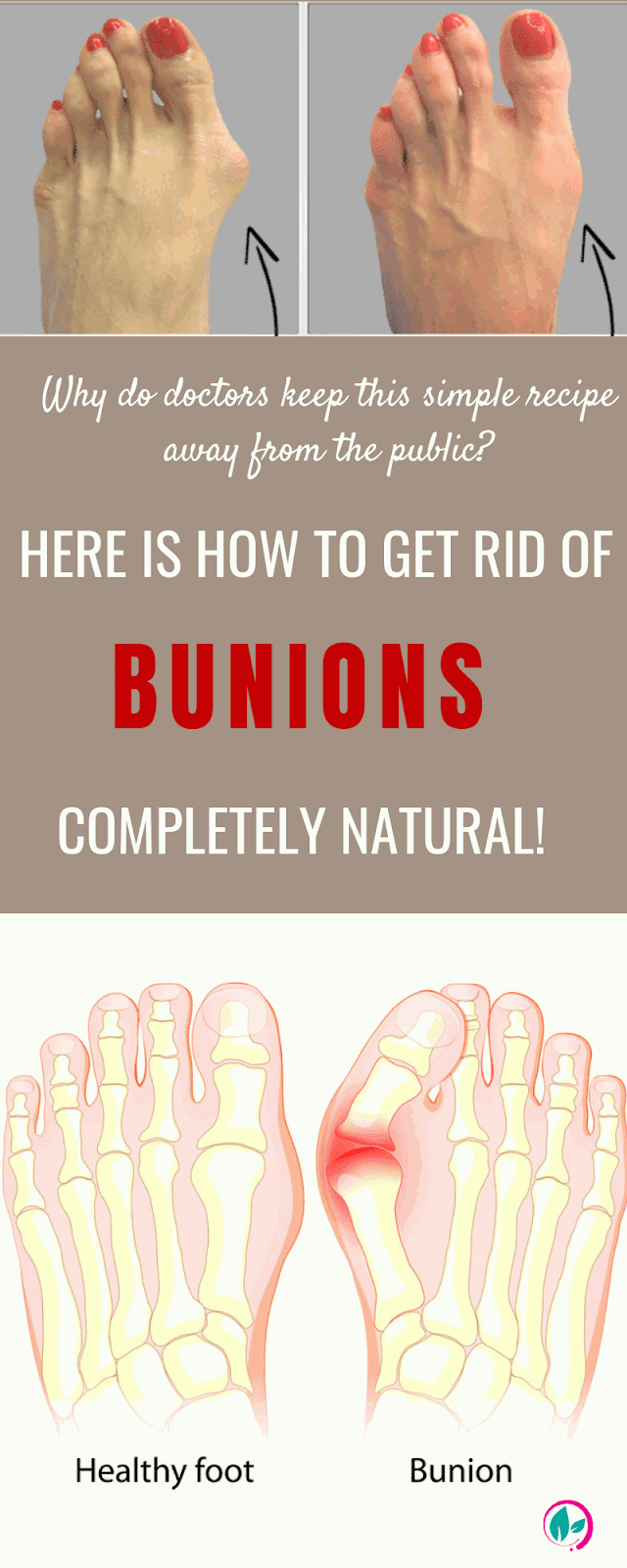 Here’s How To Get Rid Of Bunions Completely Natural!