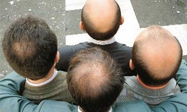 Yếu tố di truyền là nguyên nhân rụng tóc nhiều ở nam giới
