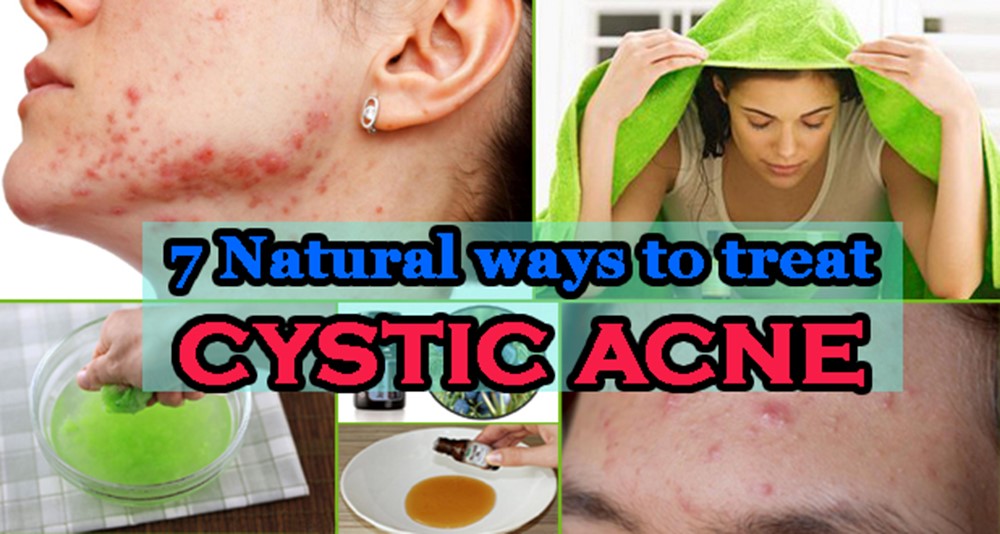 How To Get Rid of Cystic Acne with These Simple, Completely Natural