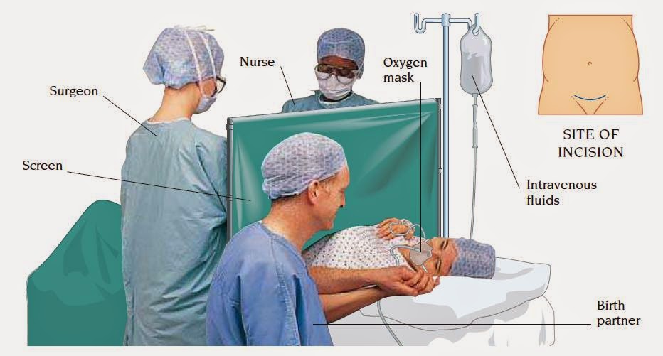 Caesarean section Nursing