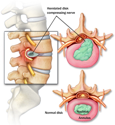 PhysioMedicalPPT: Prolapsed Intervertebral Disc