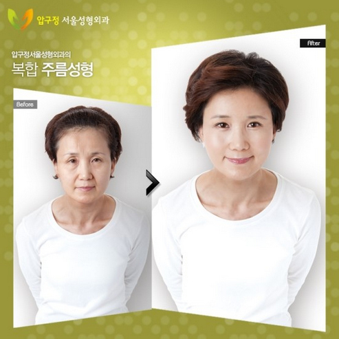Korean Plastic Surgery, Before And After Photos