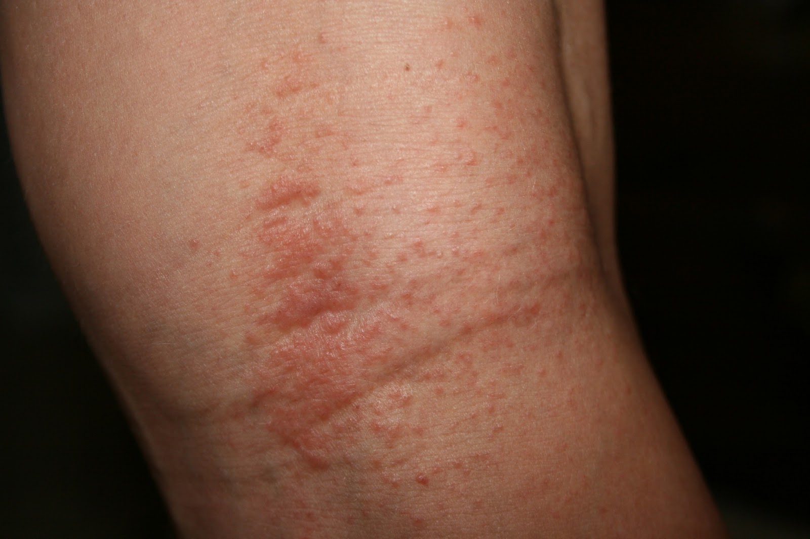 Rashes On Legs And Feet Pictures Photos