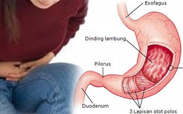 Tips Mengatasi Asam Lambung Cuma dengan Minum Teh