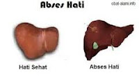 Abses hati Abses hati