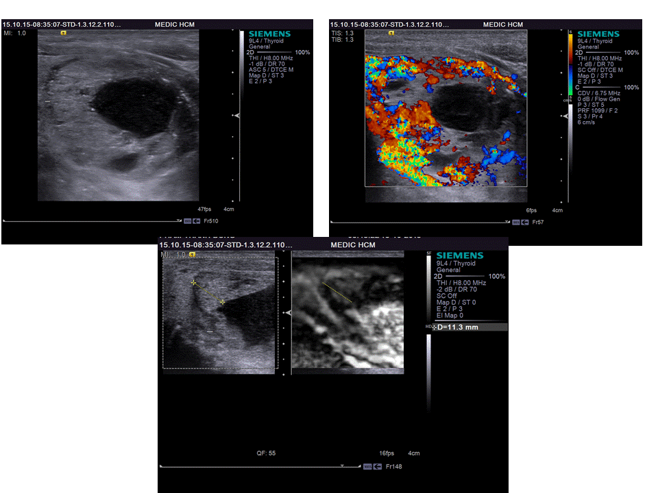 VIETNAMESE MEDIC ULTRASOUND CASE 341 THYROID TOXIC ADENOMA, Dr LÊ TỰ