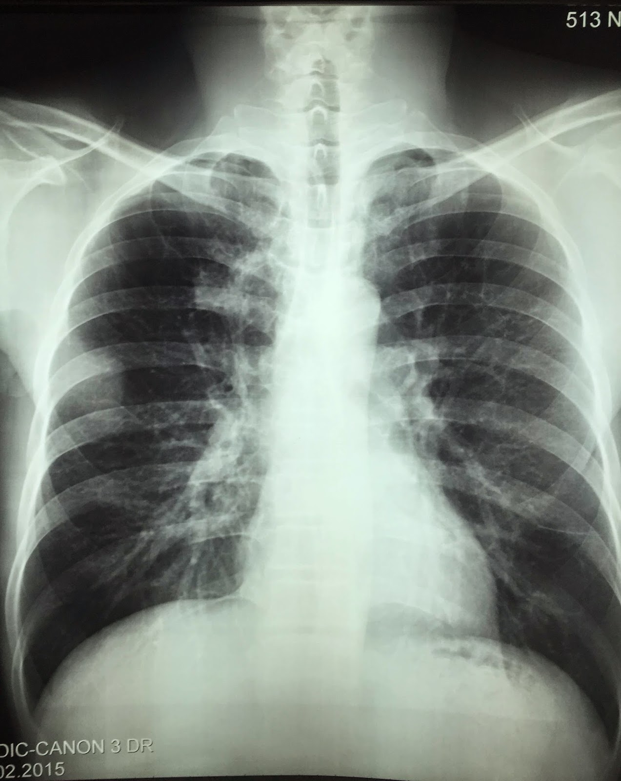 VIETNAMESE MEDIC ULTRASOUND: CASE 300: MULTIPLE BONE TUMORS, Dr PHAN