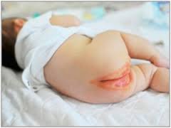 Cara Mengatasi Gatal Pada Selangkangan Bayi