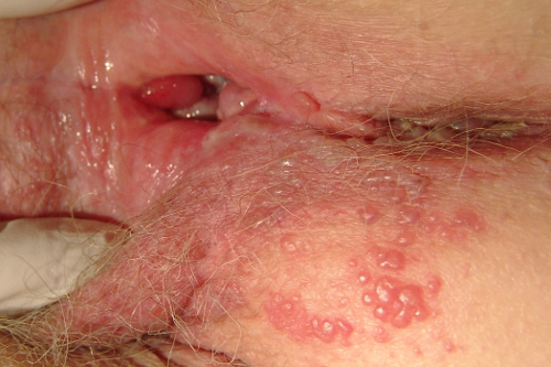 obat herpes genital