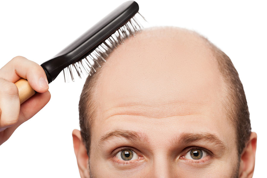 Alternativas de como tratar os cabelos calvos.