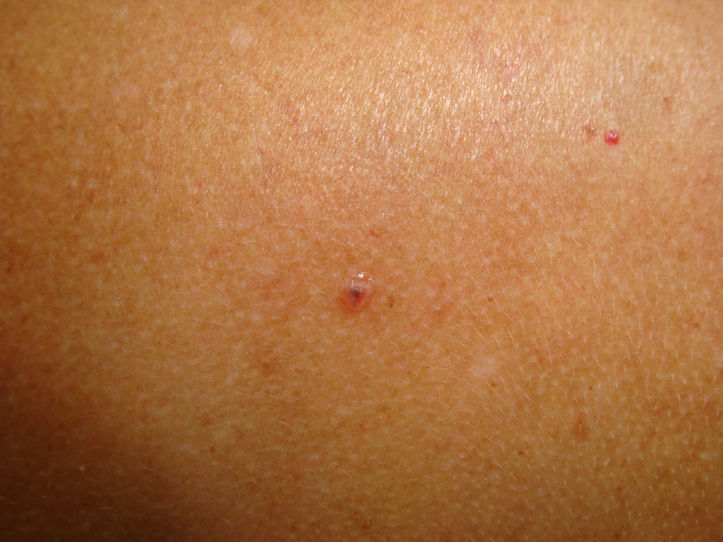 Skin Cancer Spots On Upper Leg
