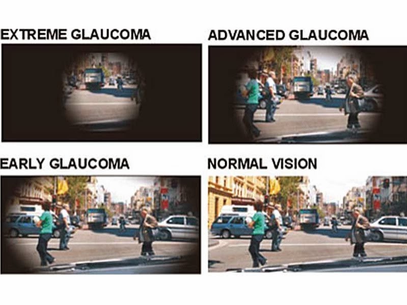 Blurred Vision and SkinnyZine