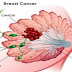 Strategy To Reduce Breast Cancer Recurrence