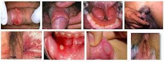Foto Bintik-Bintik Berisi Cairan, Borok, Atau Lecet Pada Daerah Kelamin ujung penis memerah