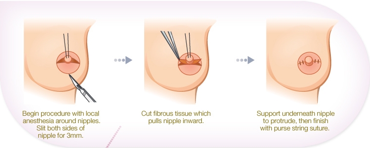 Correcting Inverted Nipples 65